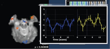 fMRT-Scan